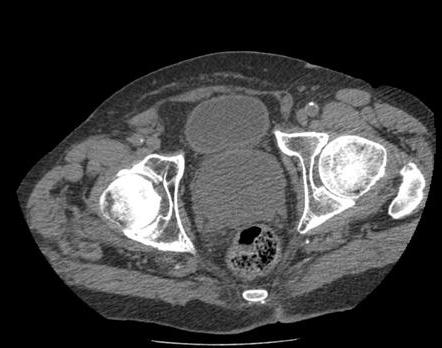 Adenomul prostatei la bărbați: etiologia, clinica și metodele de diagnostic