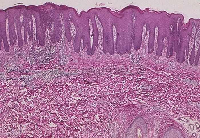 Scalp lichen: cauze, simptome, tratament