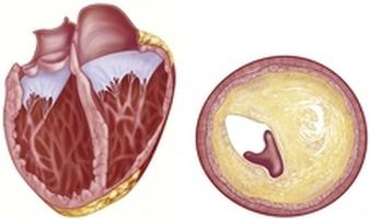 Disfuncție diastolică a ventriculului stâng al inimii. Descriere. tratament