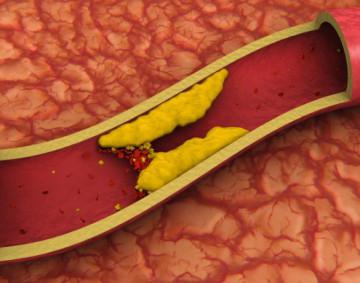 Dislipidemia - ce este această boală?