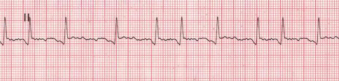 Fibrilația atrială pe ECG. Fularul atrial