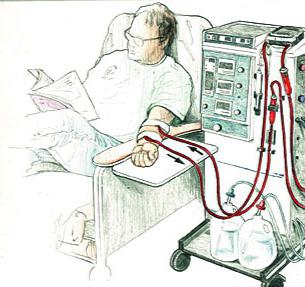 Hemodializa - ce este această procedură?