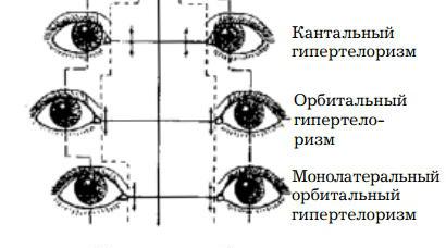 hiperteleismul orbital 