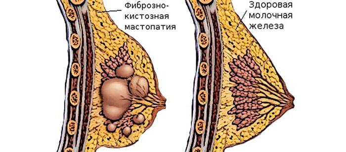 Frunze de varza cu mastopatie: cat de corect sa aplici? Mastopatia: tratamentul cu remedii folclorice la domiciliu