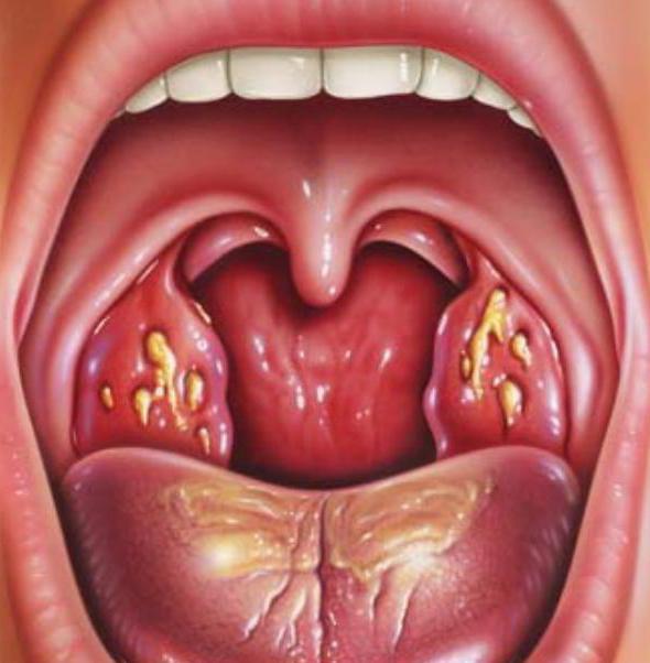 tonsilita mkg 10 clasificarea tonzilitului 