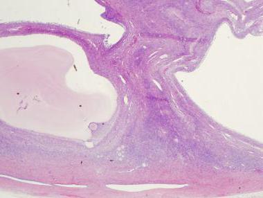 Sarcina dupa laparoscopia ovariana in cazul policicrozelor