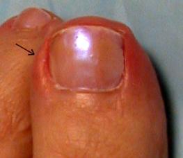 Cuiul a crescut într-un deget: cauzele și tratamentul