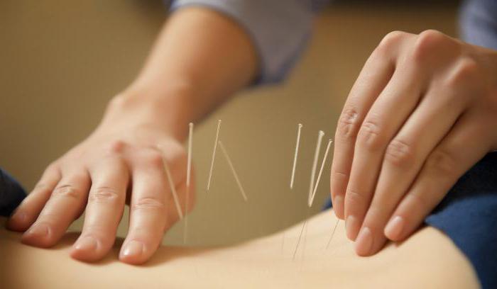 beneficiile acupuncturii