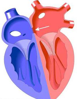 Congenital defect septal atrial 