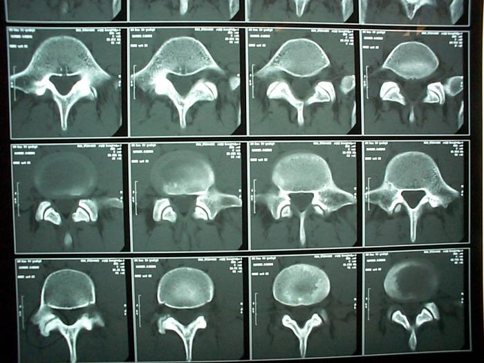 Tomografia coloanei vertebrale - diagnostic modern al bolilor spatelui