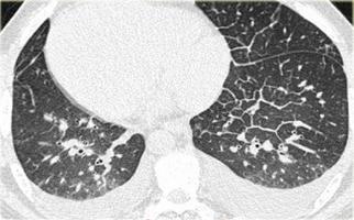 tratamentul pulmonar