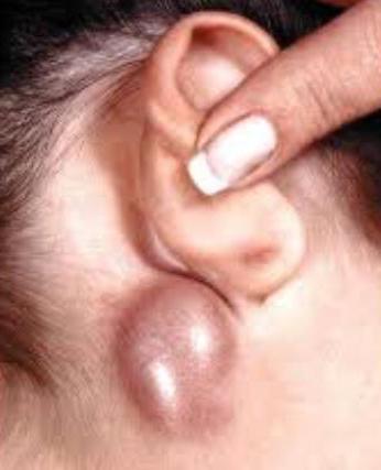 Au limfonoduri în spatele unei urechi inflamate? Principalul lucru este să lupți împotriva infecției!